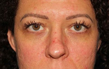 Eyelid Lift Before & After Patient #1718