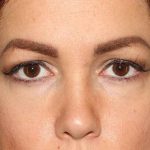 Eyelid Lift Before & After Patient #1729
