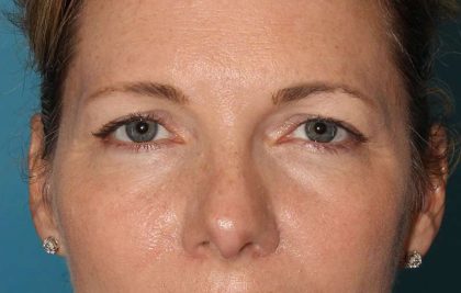 Eyelid Lift Before & After Patient #1736