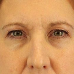 Eyelid Lift Before & After Patient #1747