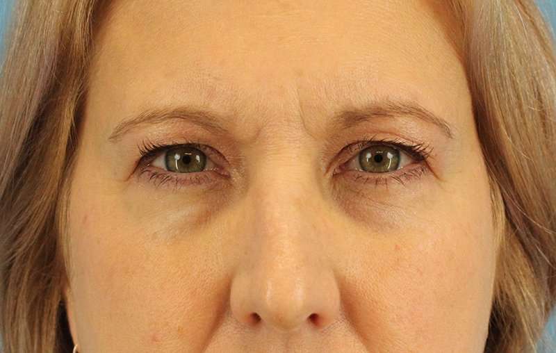 Eyelid Lift Before & After Patient #1747
