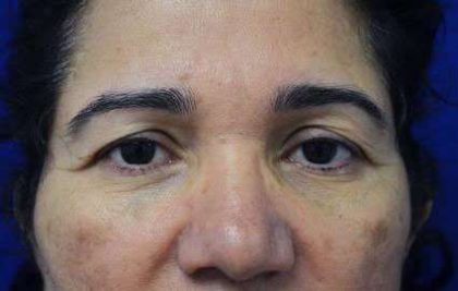 Eyelid Lift Before & After Patient #1750