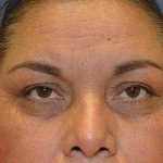 Eyelid Lift Before & After Patient #1753