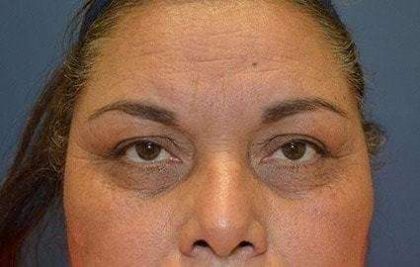 Eyelid Lift Before & After Patient #1753