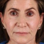 Facelift Before & After Patient #1789