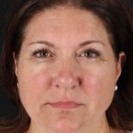 Facelift Before & After Patient #1800