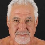Facelift Before & After Patient #1820