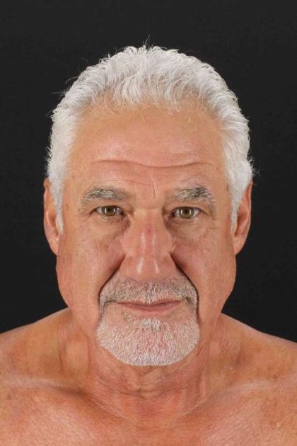 Facelift Before & After Patient #1820