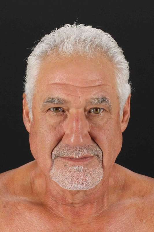 Facelift Before & After Patient #1820