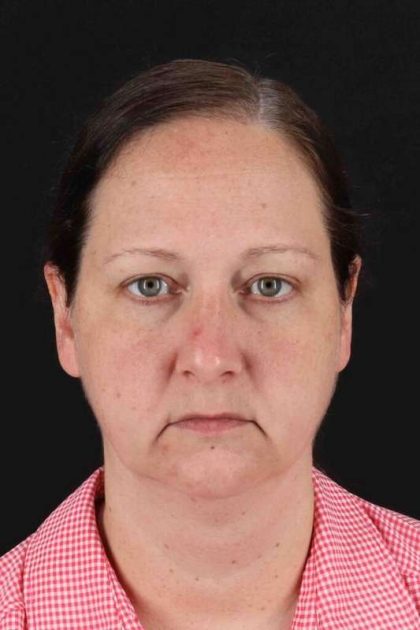 Facelift Before & After Patient #1843