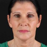Facelift Before & After Patient #1854