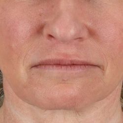 Facelift Before & After Patient #1866