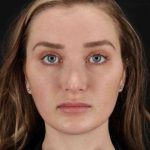 Browlift Before & After Patient #1297