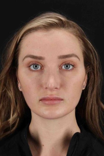 Browlift Before & After Patient #1297
