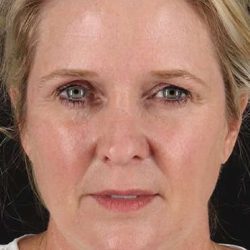 Facelift Before & After Patient #1877