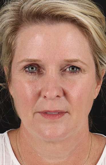 Facelift Before & After Patient #1877
