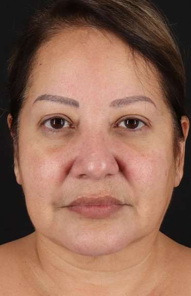 Facelift Before & After Patient #1888