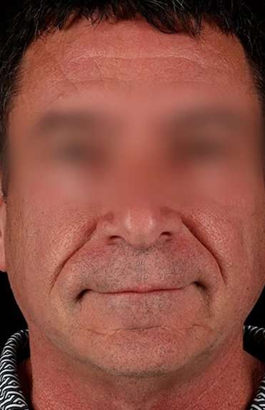 Facelift Before & After Patient #1899