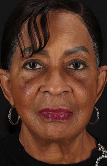 Facelift Before & After Patient #1910