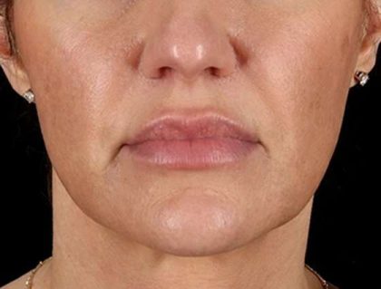 Facelift Before & After Patient #1921