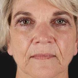 Facelift Before & After Patient #1943