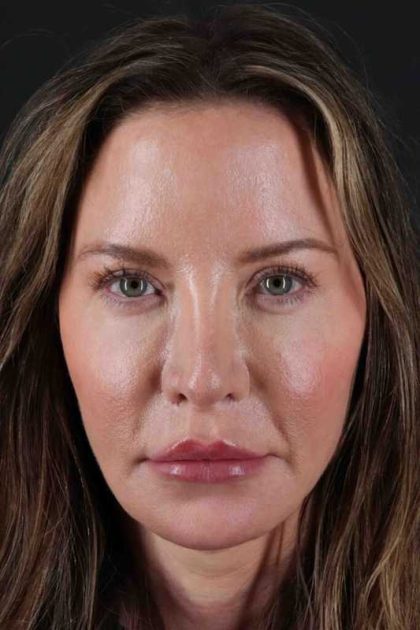 Browlift Before & After Patient #1308