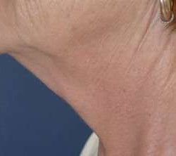 Facelift Before & After Patient #1965