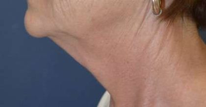 Facelift Before & After Patient #1965
