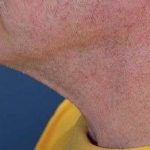 Facelift Before & After Patient #1968