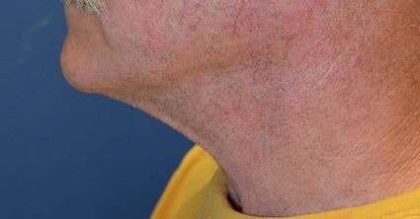 Facelift Before & After Patient #1968