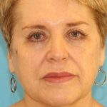Facelift Before & After Patient #1975