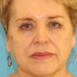 Facelift Before & After Patient #1975