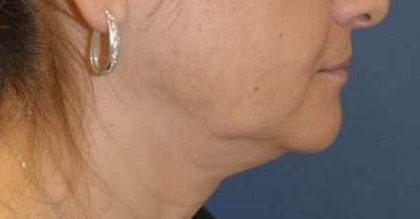 Facelift Before & After Patient #1978