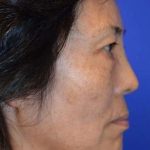 Facelift Before & After Patient #1984