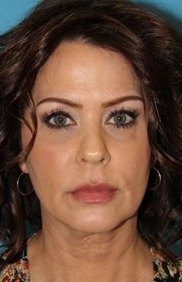Facelift Before & After Patient #1994