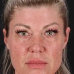 Fat Grafting To The Face Before & After Patient #2016