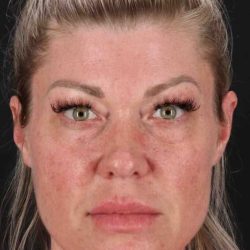 Fat Grafting To The Face Before & After Patient #2016