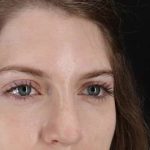 Browlift Before & After Patient #1319