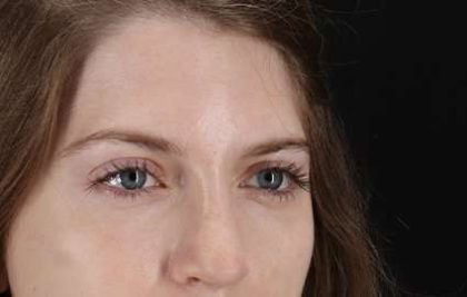 Browlift Before & After Patient #1319