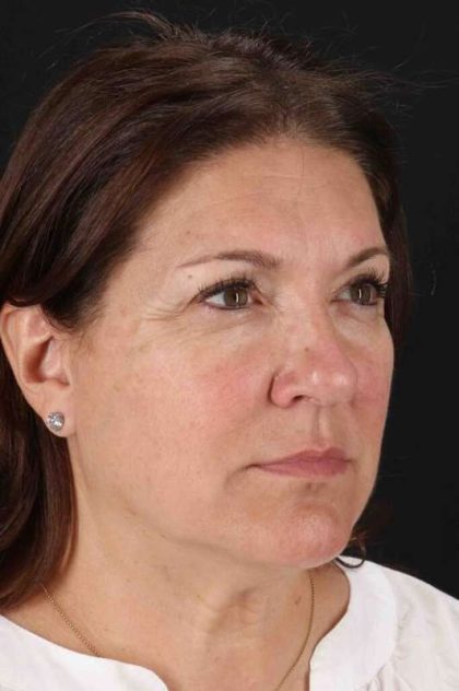 Neck Lift Before & After Patient #2463