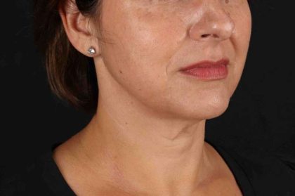 Neck Lift Before & After Patient #2472