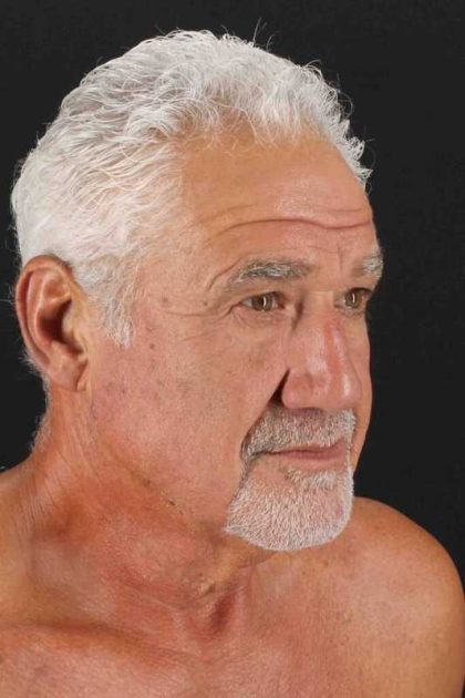 Neck Lift Before & After Patient #2483