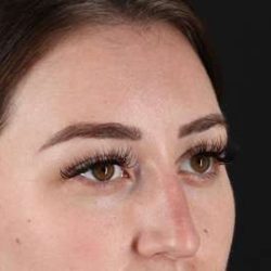Browlift Before & After Patient #1330