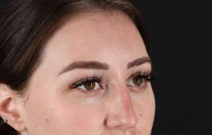 Browlift Before & After Patient #1330