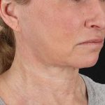 Neck Lift Before & After Patient #2571