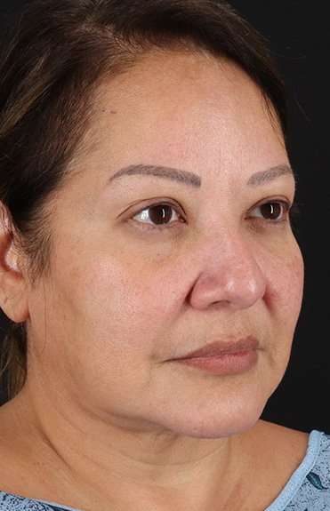 Neck Lift Before & After Patient #2593