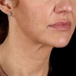 Neck Lift Before & After Patient #2626