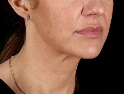 Neck Lift Before & After Patient #2626