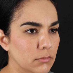 Browlift Before & After Patient #1341