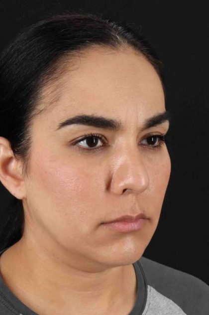 Browlift Before & After Patient #1341